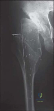 صورة طبية: استبدال مفصل الورك الكلي الناجح في خلل التنسج النمائي للورك: دليل شامل من الأستاذ الدكتور محمد هطيف