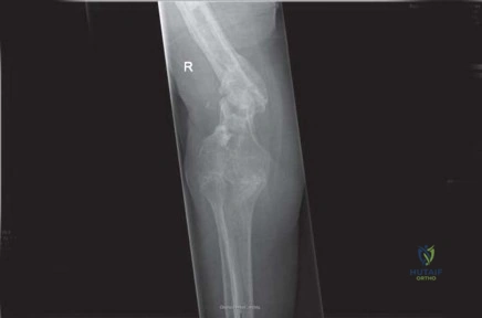 صورة طبية: جراحة استبدال مفصل الورك الملتهب في مرحلة واحدة: حل فعال وشامل مع الأستاذ الدكتور محمد هطيف