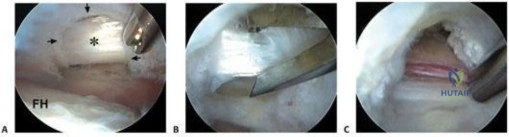 صورة طبية: توقف عن الطقطقة: الحفاظ على مفصل الورك وعلاج متلازمة الورك الطقطاق مع الأستاذ الدكتور محمد هطيف