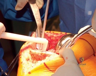 صورة طبية: إتقان موازنة الفجوة في مراجعة استبدال مفصل الركبة: تجنب الأخطاء الشائعة واستعادة الحركة مع الأستاذ الدكتور محمد هطيف