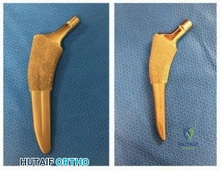 صورة توضيحية لـ ساق الفخذ المدبب: دليل شامل لتثبيت مفصل الورك اللاأسمنتي طويل الأمد مع الأستاذ الدكتور محمد هطيف في صنعاء