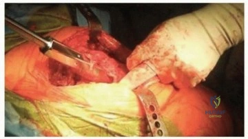 صورة طبية: تحسين جراحة مراجعة استبدال مفصل الورك الكلي بسيقان التيتانيوم المدببة ذات الفلوس: دليل شامل للمرضى مع الأستاذ الدكتور محمد هطيف