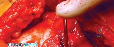 صورة طبية: المدخل الخلفي الجانبي لجراحة استبدال مفصل الورك الكلي: دليل شامل للمرضى في صنعاء مع الأستاذ الدكتور محمد هطيف