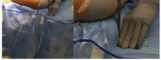 صورة توضيحية لـ سيقان مفصل الفخذ المسامية الموسعة: نجاح مثبت وتثبيت فائق لمفاصل ورك تدوم طويلاً في صنعاء مع الأستاذ الدكتور محمد هطيف
