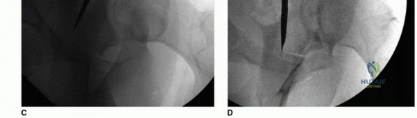 صورة توضيحية لـ جراحة قطع العظم حول الحُق وقطع عظم الفخذ: إعادة محاذاة مفصل الورك لراحة دائمة مع الأستاذ الدكتور محمد هطيف