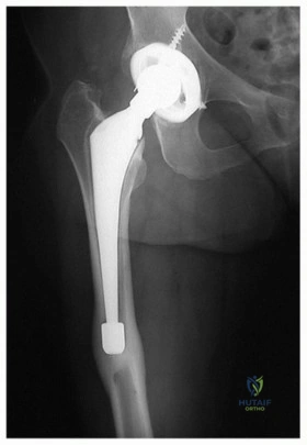 صورة طبية: إتقان مراجعة استبدال مفصل الورك: استراتيجيات تحديات الأنسجة المحلية الضارة