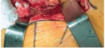 صورة توضيحية لـ استبدال مفصل الورك بالنهج الجانبي المباشر: دليلك الشامل لاستعادة الحركة والدقة