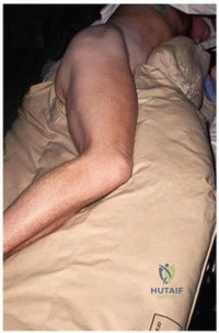 وضع المريض يسمح بالوصول إلى الطرف بالكامل.