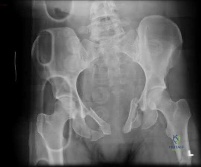 صورة طبية: دليل شامل لكسور وإصابات الجهاز الحركي: رعاية متقدمة في صنعاء مع الأستاذ الدكتور محمد هطيف