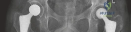 صورة طبية: استبدال مفصل الورك الكلي الثنائي المتزامن غير الاسمنتي: دليل شامل من الأستاذ الدكتور محمد هطيف