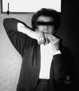 صورة توضيحية لـ كسر عظم العضد البعيد المعقد داخل المفصل: دليل شامل للمرضى مع الأستاذ الدكتور محمد هطيف