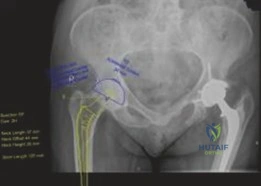 صورة توضيحية لـ مفصل الورك الصناعي الهجين: حل شامل ومتقدم لآلام المفاصل المعقدة