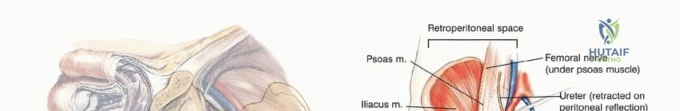 صورة توضيحية لـ استئصال نصف الحوض بالرفرفة الخلفية: دليل شامل للمرضى مع الأستاذ الدكتور محمد هطيف