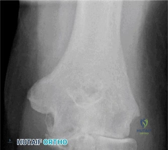 صورة رنين مغناطيسي لتمزق الأربطة