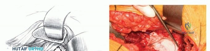 صورة توضيحية لـ سلامة خلع الورك الجراحي: الدور الحيوي للشريان الفخذي المنعطف الإنسي في الحفاظ على صحة الورك