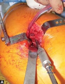صورة طبية: استبدال مفصل الورك الكلي في العيادات الخارجية: دليل شامل من الأستاذ الدكتور محمد هطيف في صنعاء