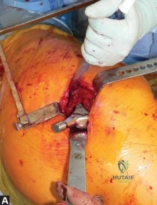 صورة طبية: استبدال مفصل الورك الكلي في العيادات الخارجية: دليل شامل من الأستاذ الدكتور محمد هطيف في صنعاء