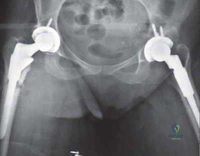 صورة طبية: استبدال مفصل الورك الكلي الناجح في خلل التنسج النمائي للورك: دليل شامل من الأستاذ الدكتور محمد هطيف