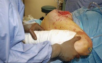 صورة توضيحية لـ النهج الخلفي لمفصل الورك: دليل شامل لاستعادة الحركة في صنعاء مع الأستاذ الدكتور محمد هطيف