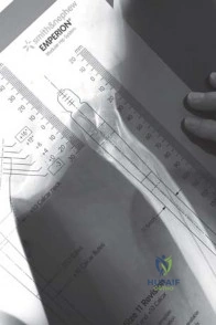 صورة طبية: استبدال مفصل الورك الكلي الناجح في خلل التنسج النمائي للورك: دليل شامل من الأستاذ الدكتور محمد هطيف
