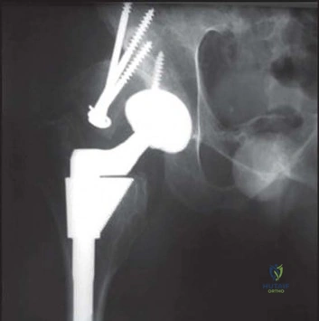 صورة طبية: استبدال مفصل الورك الكلي الناجح في خلل التنسج النمائي للورك: دليل شامل من الأستاذ الدكتور محمد هطيف