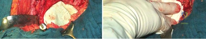 صورة طبية: جراحة استبدال مفصل الورك الملتهب في مرحلة واحدة: حل فعال وشامل مع الأستاذ الدكتور محمد هطيف