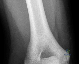 صورة طبية: آلام الكتف والمرفق: دليلك الشامل للتشخيص الدقيق والعلاج الفعال في صنعاء مع الأستاذ الدكتور محمد هطيف
