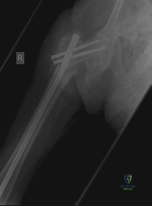 Illustration 4 for Lower Limb Trauma: Decipher Anteroposterior (AP) Figure for Exams