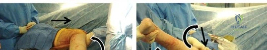 صورة طبية: إتقان توازن الأنسجة الرخوة لمفصل ورك صناعي مثالي: دليل شامل للمرضى مع الأستاذ الدكتور محمد هطيف