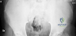 صورة توضيحية لـ جراحة تقليل رأس الفخذ المحافظة: استعادة وظيفة الورك لشباب صنعاء مع الأستاذ الدكتور محمد هطيف