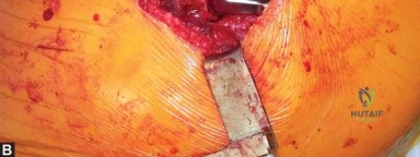 صورة طبية: استبدال مفصل الورك الكلي في العيادات الخارجية: دليل شامل من الأستاذ الدكتور محمد هطيف في صنعاء
