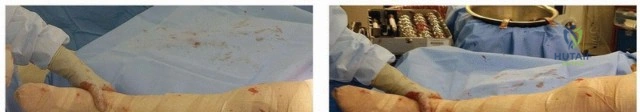 صورة طبية: ساق الفخذ المدبب: دليل شامل لتثبيت مفصل الورك اللاأسمنتي طويل الأمد مع الأستاذ الدكتور محمد هطيف في صنعاء