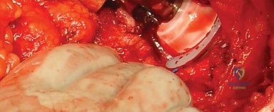 صورة طبية: المدخل الخلفي الجانبي لجراحة استبدال مفصل الورك الكلي: دليل شامل للمرضى في صنعاء مع الأستاذ الدكتور محمد هطيف
