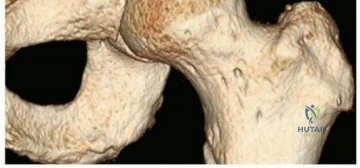 صورة توضيحية لـ منظار مفصل الورك لعلاج الانحشار الفخذي الحقي: دليل شامل من الأستاذ الدكتور محمد هطيف في صنعاء