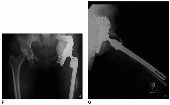 صورة طبية: الأجهزة ثلاثية الشفاه المخصصة: حل مبتكر لفقدان عظم الحوض الشديد واستعادة وظيفة مفصل الورك