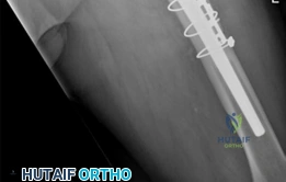 صورة توضيحية لـ جراحة مراجعة مفصل الورك: استعادة الثبات بكؤوس التانتالوم المسامية في صنعاء