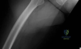 Illustration of case title uncemented - Dr. Mohammed Hutaif