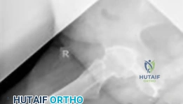 صورة طبية: مفصل الورك الصناعي الهجين: حل شامل ومتقدم لآلام المفاصل المعقدة