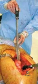 تفاصيل مرئية 31 - الخلاص من آلام سرطان العظام: استبدال مفصل الورك بالداني من الفخذ