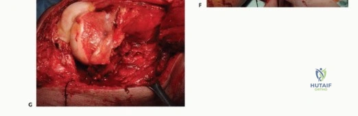 صورة طبية: النقائل العظمية الفخذية: دليل شامل للعلاج واستعادة الوظيفة مع الأستاذ الدكتور محمد هطيف في صنعاء