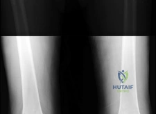 صورة توضيحية لـ جراحة استبدال مفصل الركبة التقوسي: الحل النهائي لآلام الركبة في صنعاء | الأستاذ الدكتور محمد هطيف
