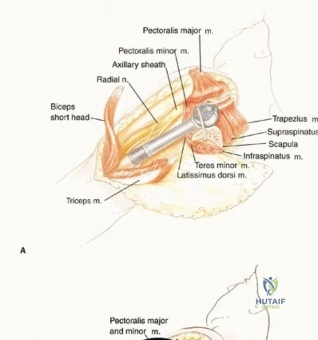 صورة توضيحية لـ استئصال الجزء القريب من عظم العضد بتقنيات الحفاظ على الطرف: دليل شامل للمرضى مع الأستاذ الدكتور محمد هطيف