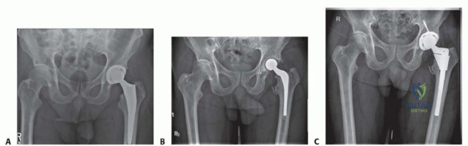 صورة توضيحية لـ جراحة إعادة زرع مفصل الورك الحل النهائي للمفاصل الصناعية الملتهبة في صنعاء مع الأستاذ الدكتور محمد هطيف
