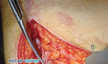صورة أشعة توضح كسر في عنق عظمة الفخذ