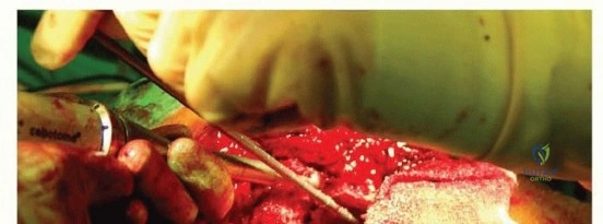 صورة توضيحية لـ وحدة إكستر للورك: إتقان تطعيم العظام بالضغط لمعالجة فقدان عظم الفخذ في صنعاء مع الأستاذ الدكتور محمد هطيف