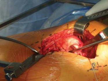 صورة طبية: استبدال مفصل الورك الكلي الناجح في خلل التنسج النمائي للورك: دليل شامل من الأستاذ الدكتور محمد هطيف