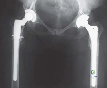 صورة طبية: استبدال مفصل الورك الكلي الناجح في خلل التنسج النمائي للورك: دليل شامل من الأستاذ الدكتور محمد هطيف