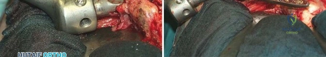 صورة طبية: جراحة استبدال مفصل الورك الملتهب في مرحلة واحدة: حل فعال وشامل مع الأستاذ الدكتور محمد هطيف