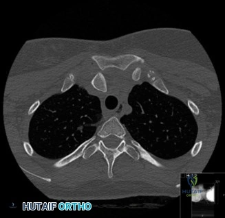 صورة طبية: دليلك الشامل لآلام الكتف: التشخيص والعلاج مع الأستاذ الدكتور محمد هطيف في صنعاء