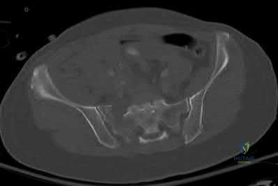 صورة طبية: دليل شامل لكسور وإصابات الجهاز الحركي: رعاية متقدمة في صنعاء مع الأستاذ الدكتور محمد هطيف